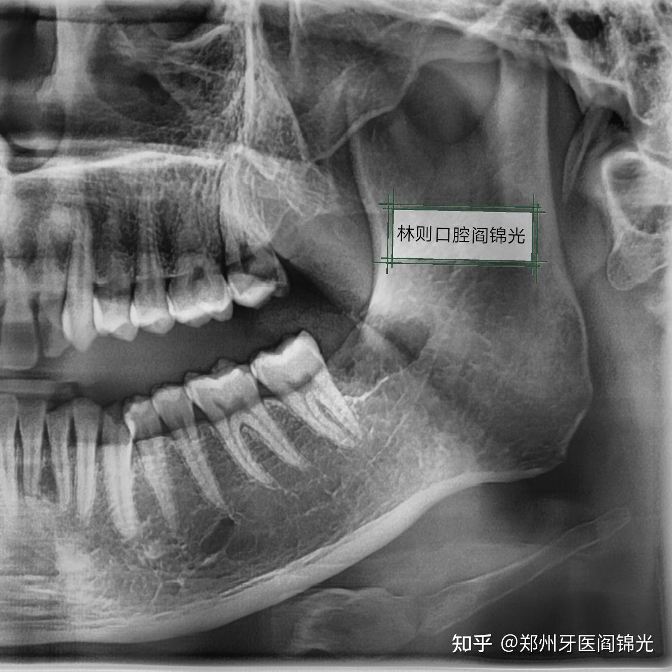 拔智齿牙槽骨突出图片