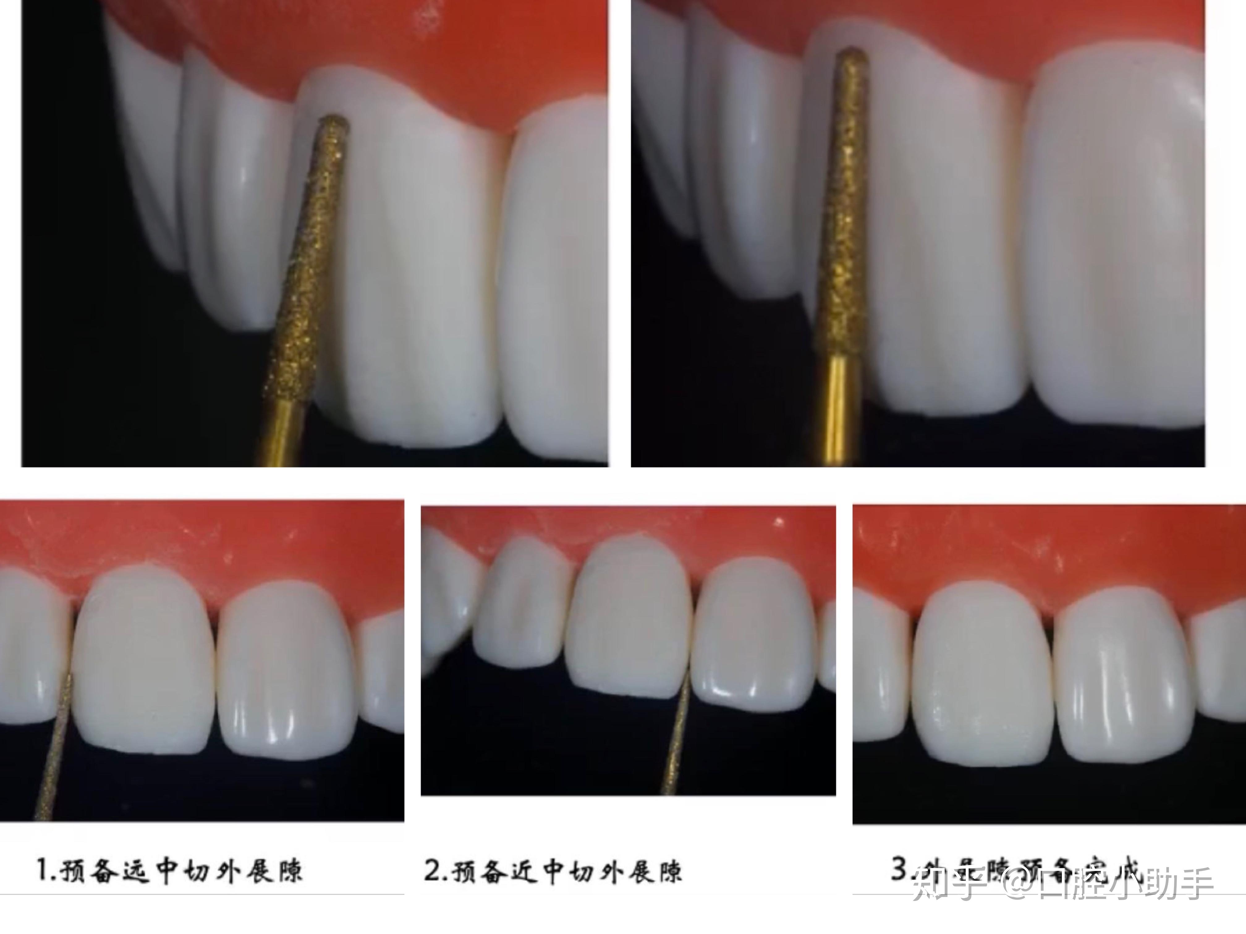 金牌技师34期王林未美学修复牙体预备要领四之贴面的分类预备