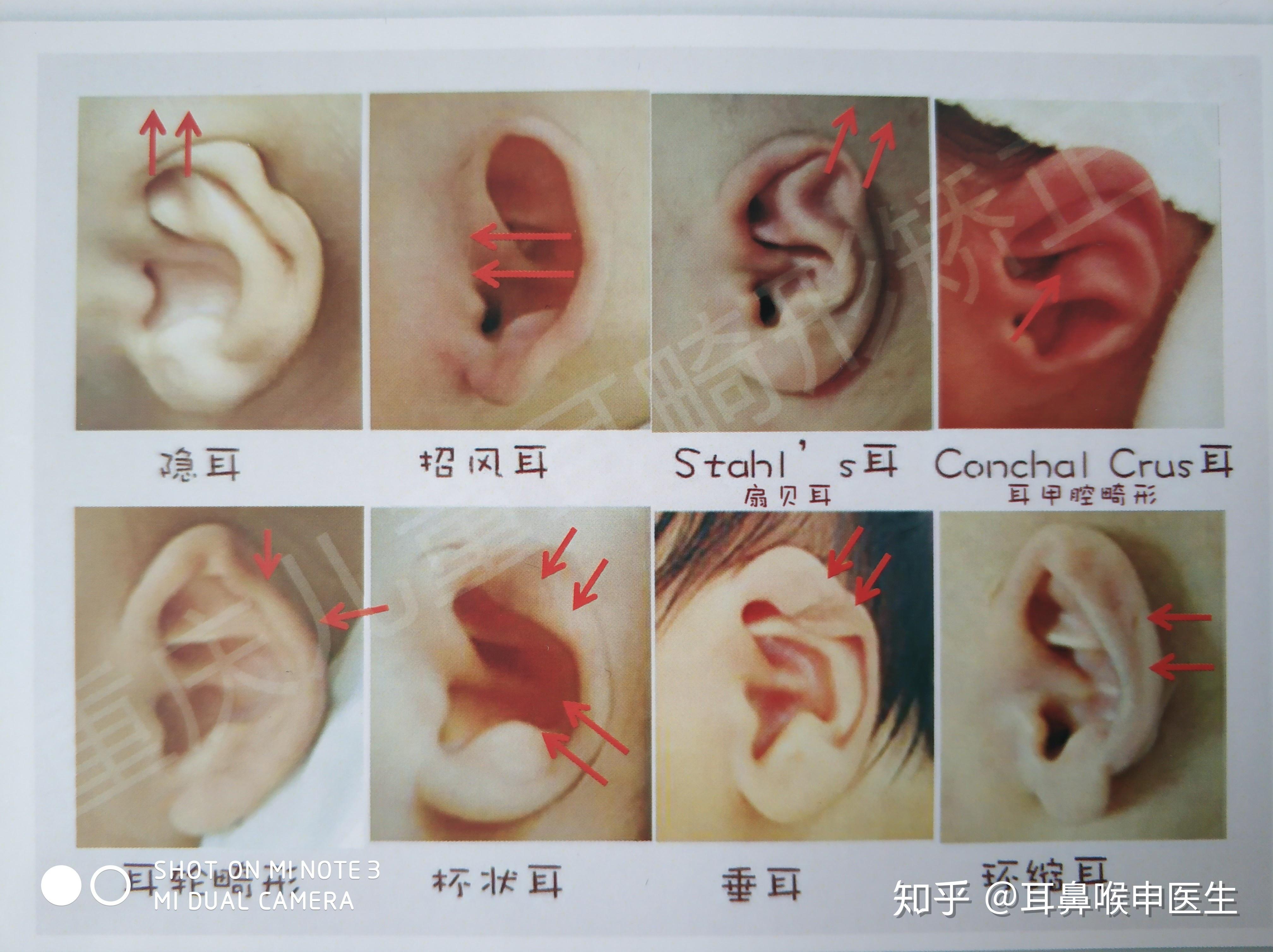 新生儿耳朵畸形怎么办？新生儿外耳畸形怎么治疗？_小耳畸形_小耳畸形 - 好大夫在线