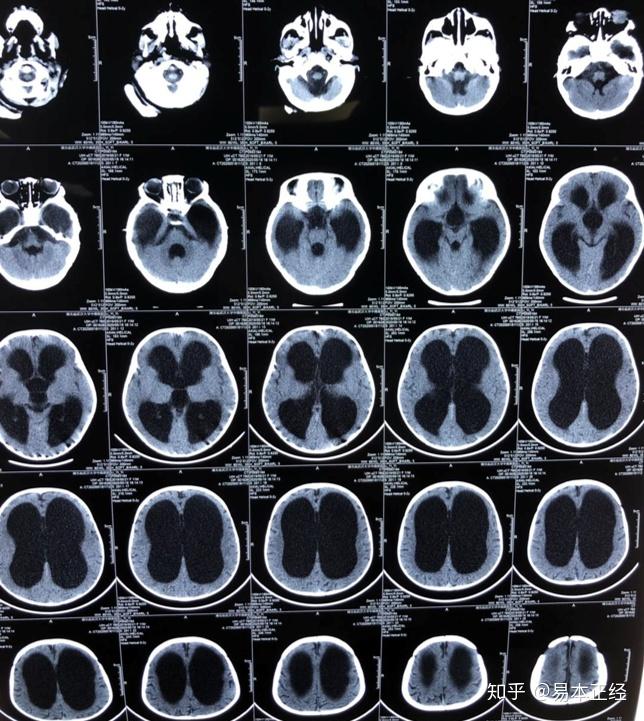 术前头部ct示四个脑室均扩大,黑色区域为脑室.