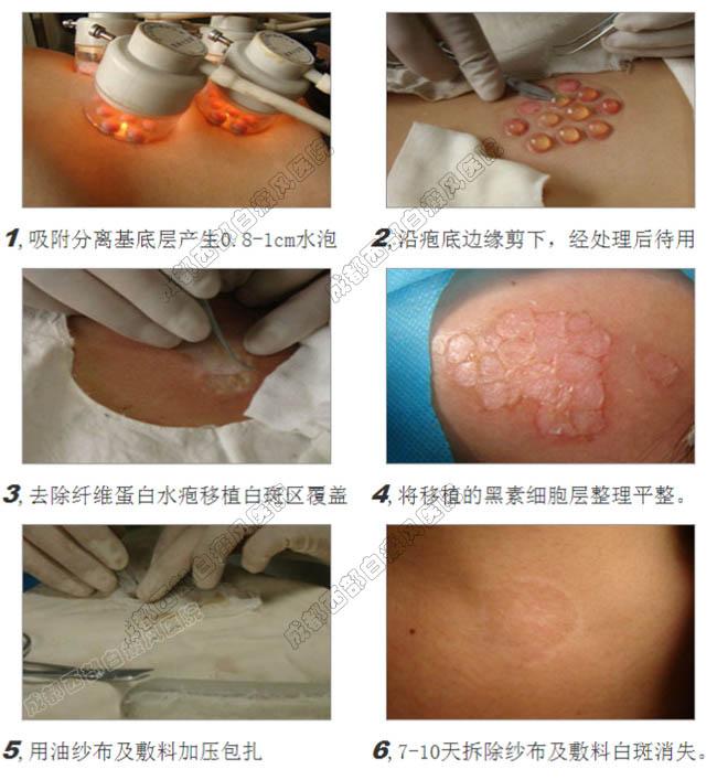 黑色素种植成95患者的快速祛白疗法原因令人折服