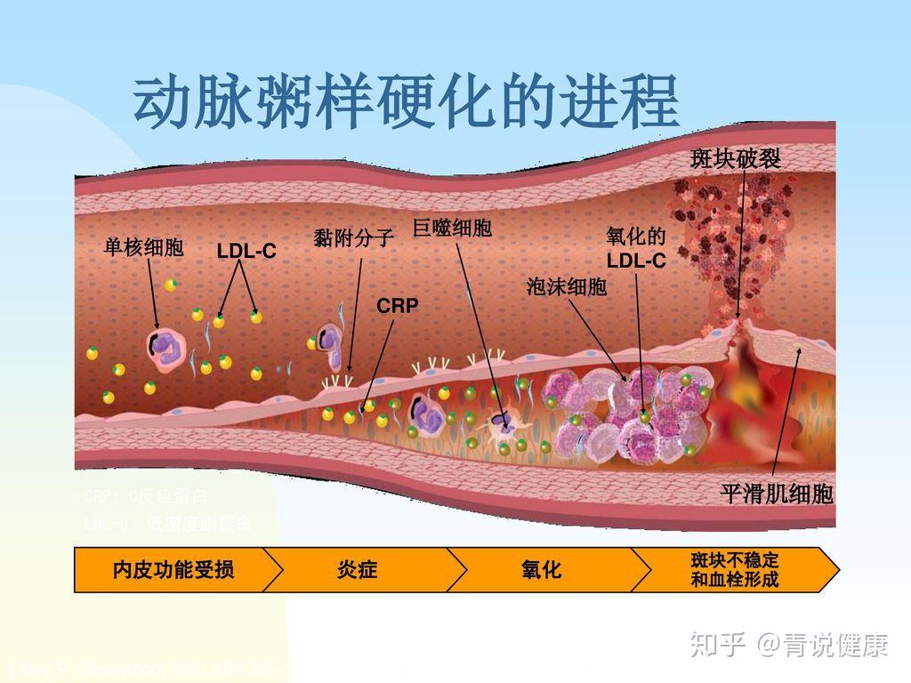 动脉硬化、粥样硬化、斑块有何不同，应如何调理！ 知乎