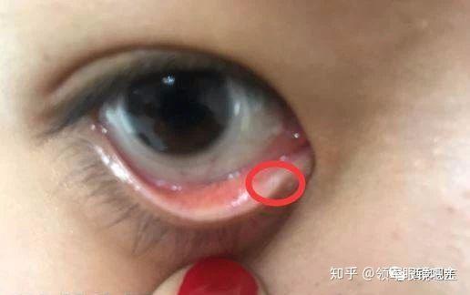 但其实不是这样,这个小洞是眼睛引流系统的一部份,当泪腺产生泪水后