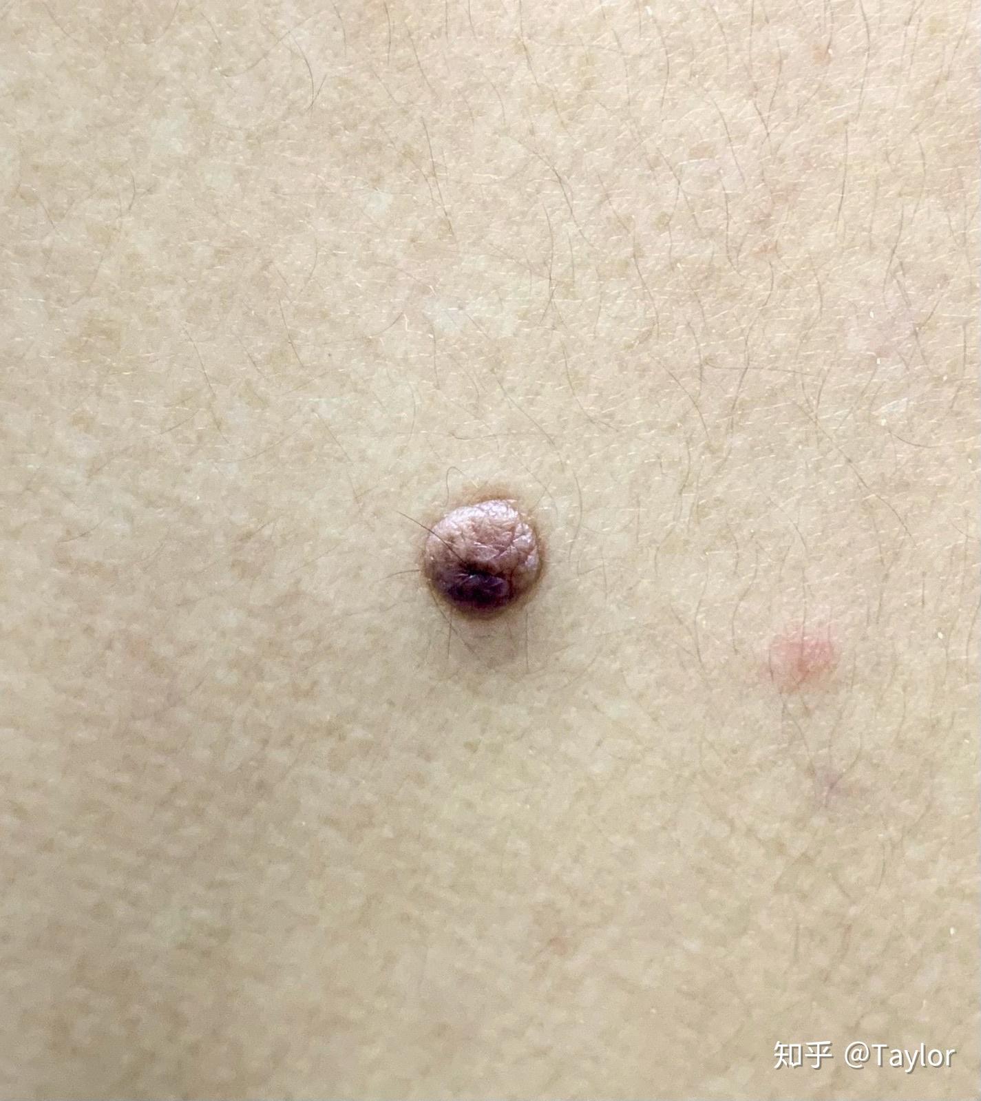 告别点背之祛痣经验分享