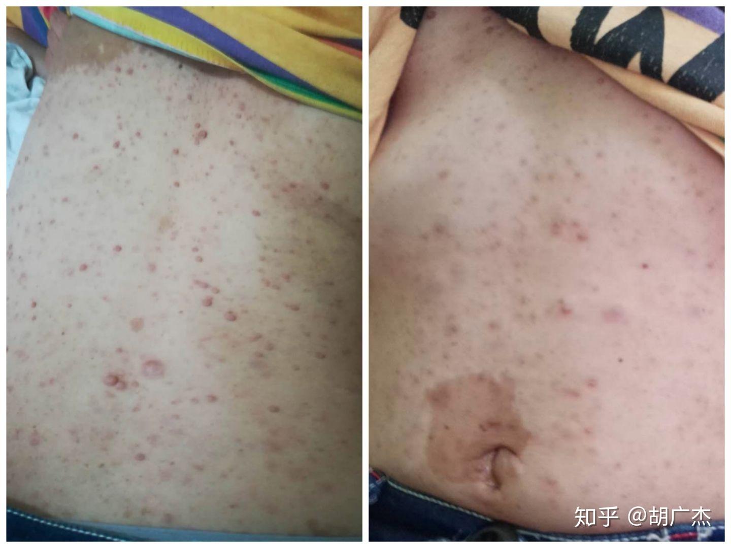 神经纤维瘤调理案例7天的变化邵女士