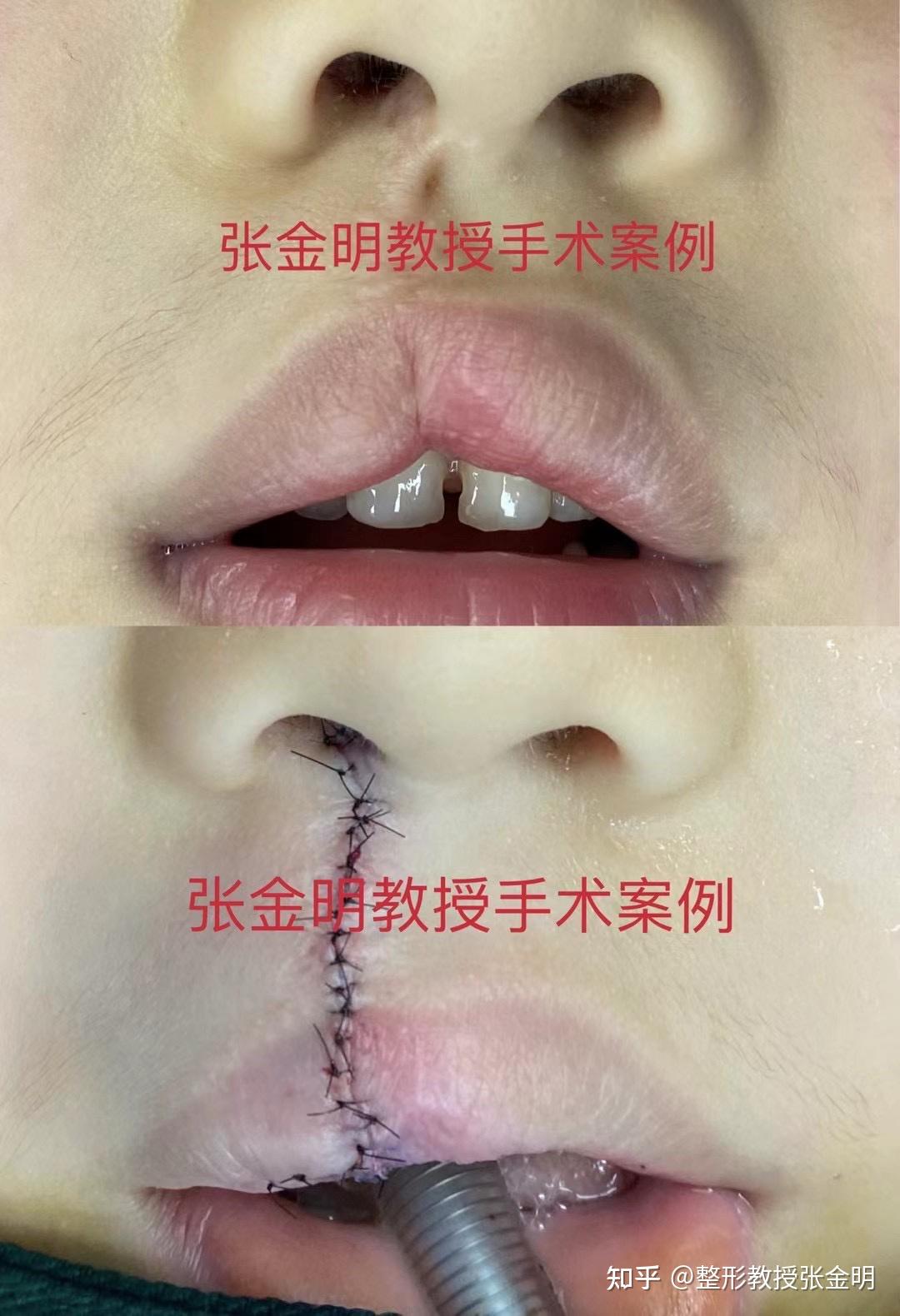 儿童唇腭裂手术需要注意什么?