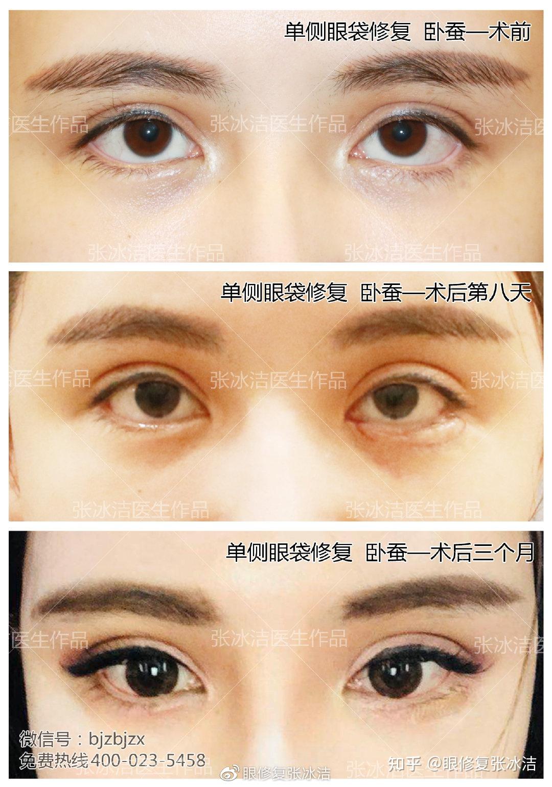 张冰洁谈眼袋失败修复丨巧用自体真皮卧蚕修复眼袋术后下睑外翻露红
