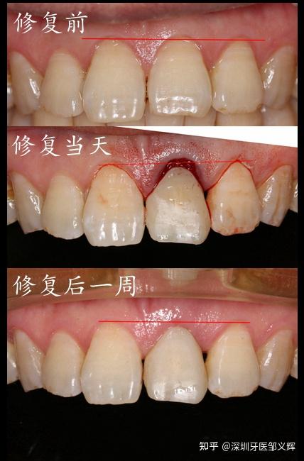 前牙种植即刻修复引导牙龈生长