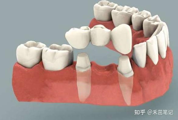 缺了一顆牙,種植牙,活動假牙和烤瓷牙哪個更好? - 知乎