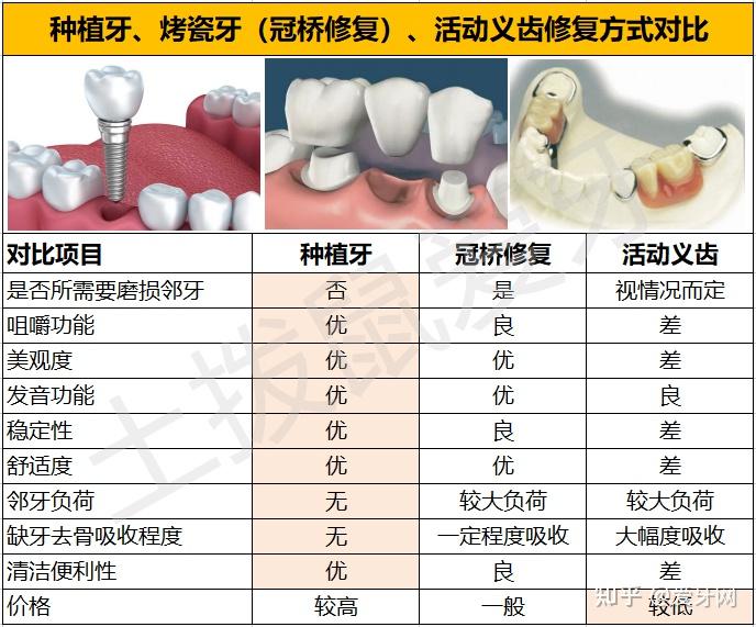 种植牙和烤瓷牙活动义齿到底有什么区别各自有什么优点和缺点哪种治疗