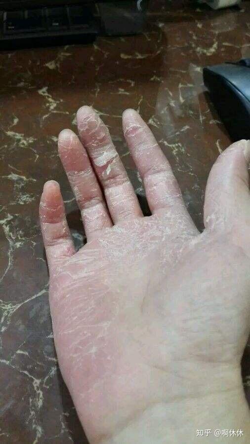 手老脱皮怎么办