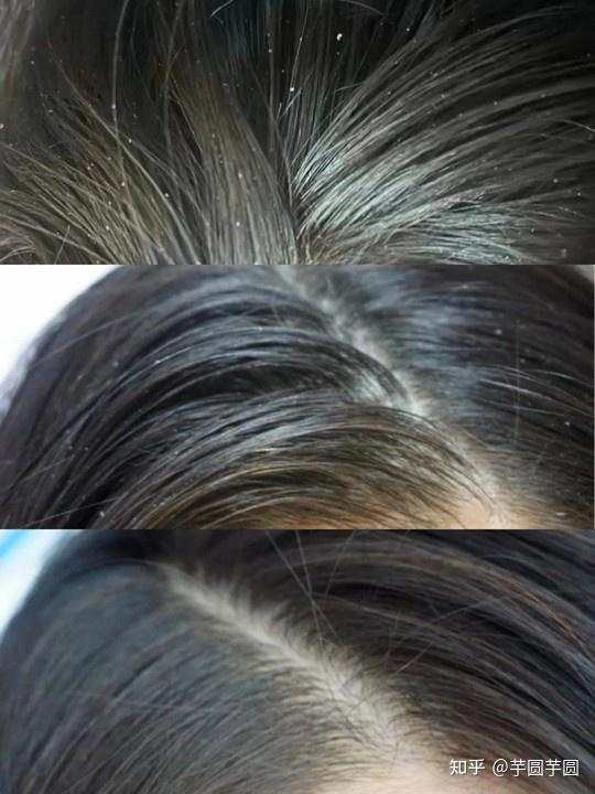 好用的洗发水没有头皮屑 v2-f7b65495b9247030eb9276c18ec8d18f_r.jpg