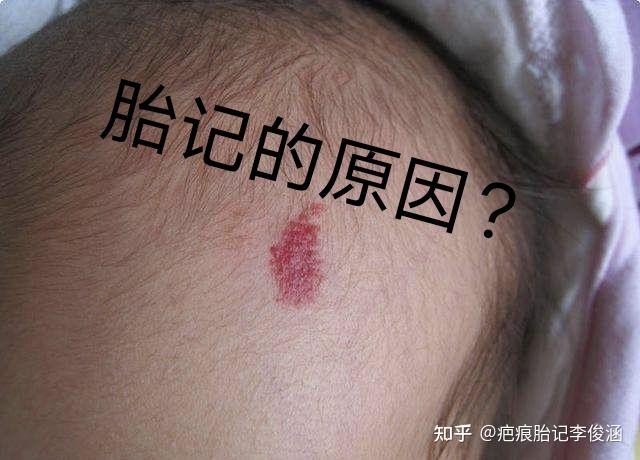 胎记的原因? - 知乎