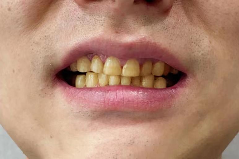 黄牙齿照片图片