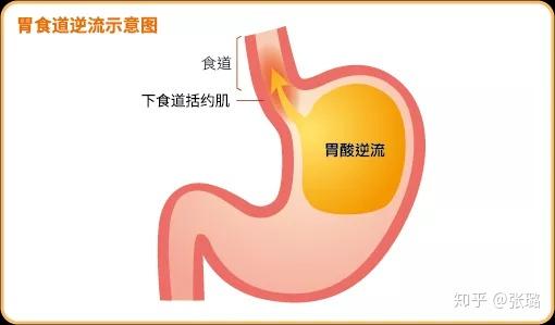 健康保胃战烧心别轻忽胃食道逆流