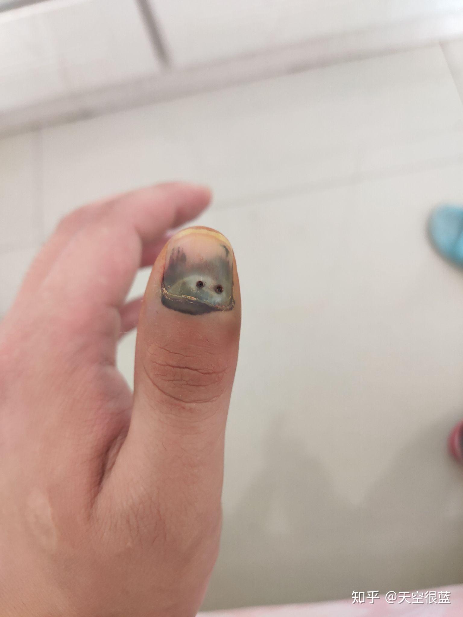 指甲被车门夹瘀血恢复过程