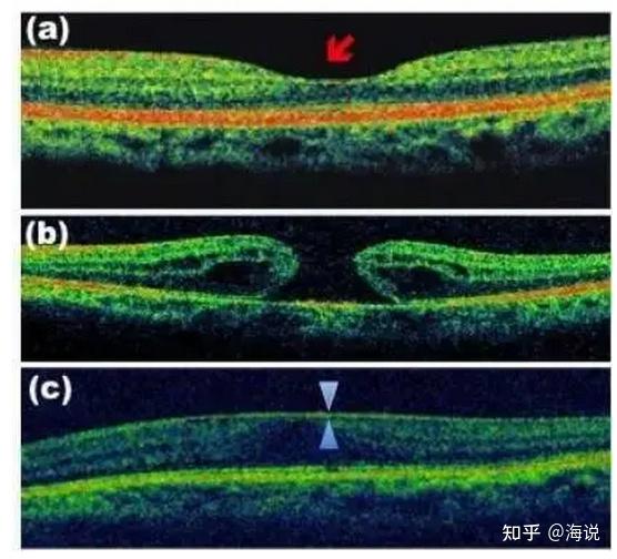 科普文里常说的定期查眼底,查什么?怎么查?哪些人需要查? - 知乎