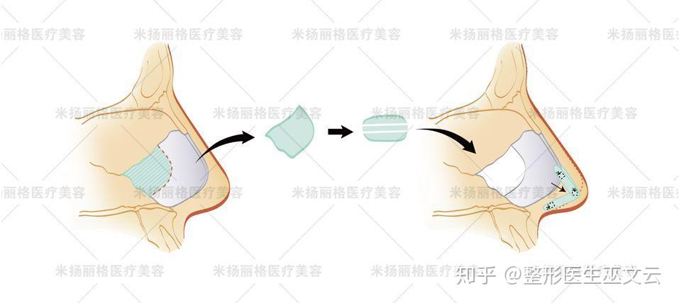 肋软骨是弯的)a平直,可直线抬高和延长鼻尖;②    鼻中隔软骨的特性