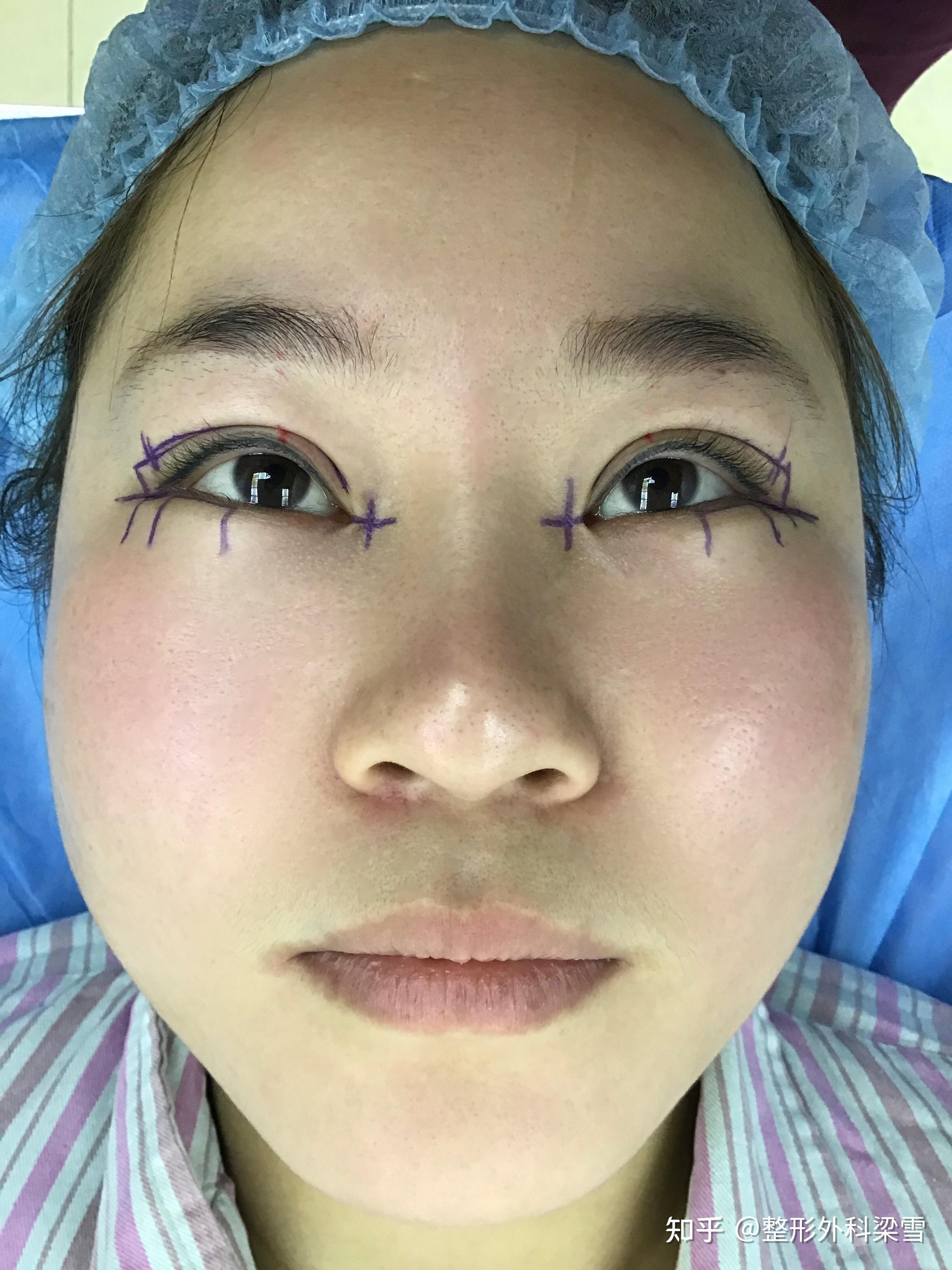 3号作品连云港双眼皮修复手术画线篇