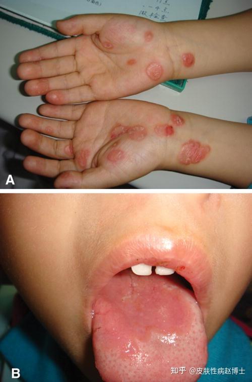 幼儿梅毒症状图片图片