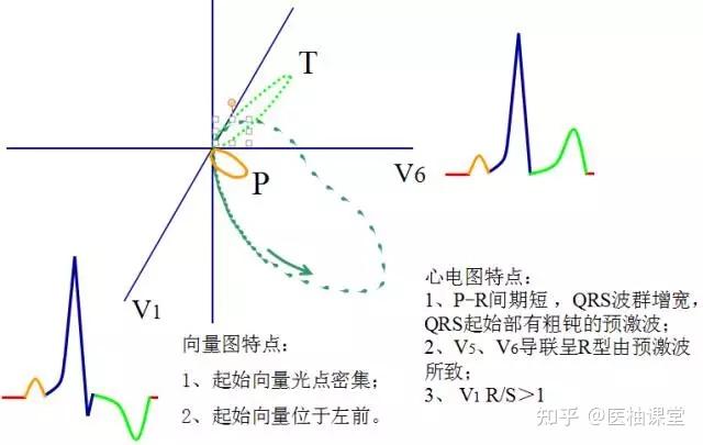 正常心室除极顺序图解图片