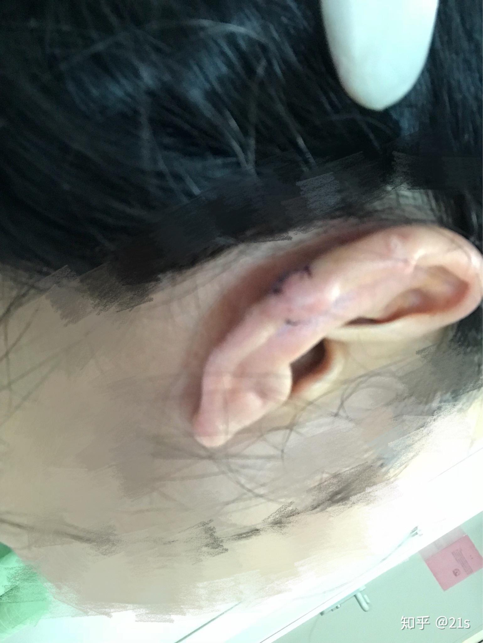 耳部瘢痕疙瘩治疗记录