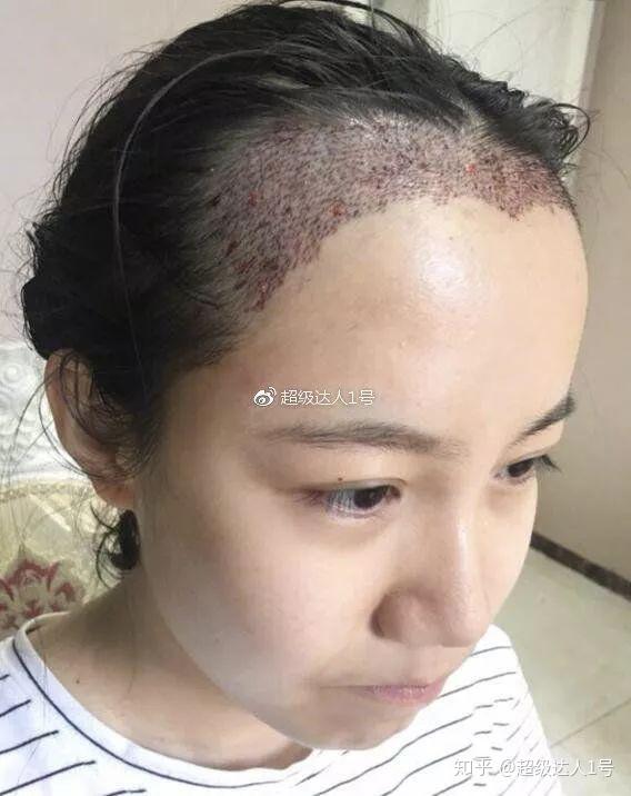 发际线太秃了 细软发质做植发5个小时想哭.
