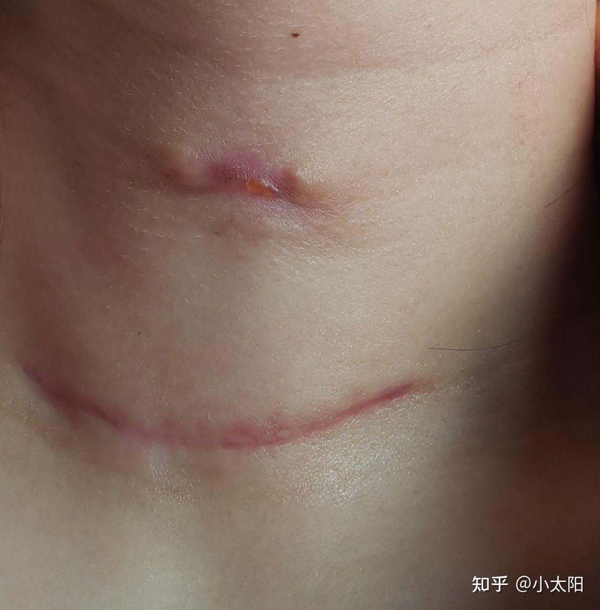 甲状腺乳头状癌(左边半切)疤痕恢复情况 