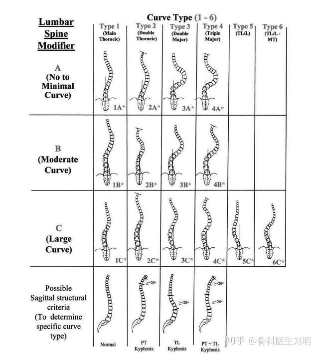 脊柱側彎分型