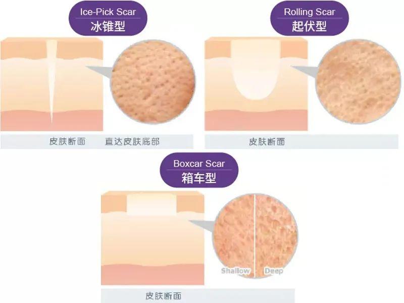 深坑痘印,面部毛细血管扩张,提高皮肤紧致,妊娠纹,肥胖纹,膨胀纹等有