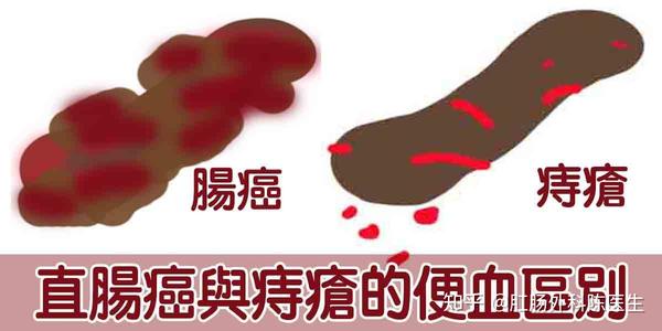 大便带血都是肠癌吗?一站让你学会居家如何初步判断便血性质 - 知乎