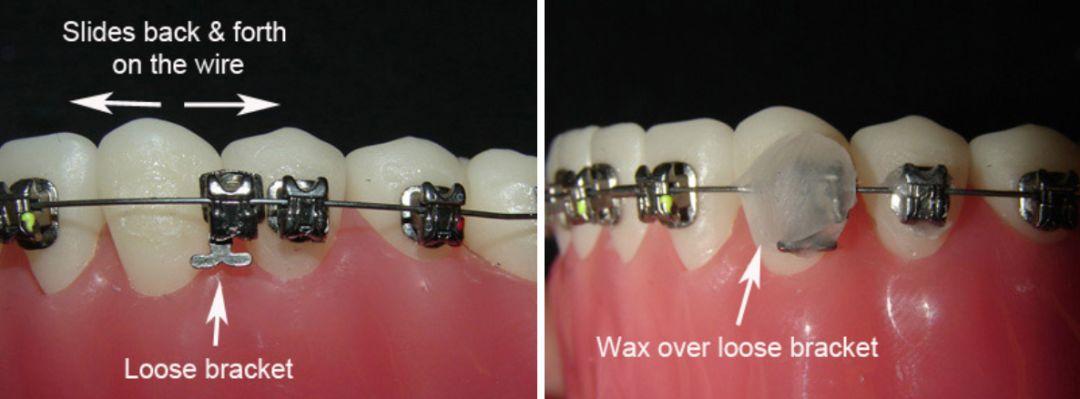 陶瓷自锁冰晶固定矫正种类这么多该怎么选