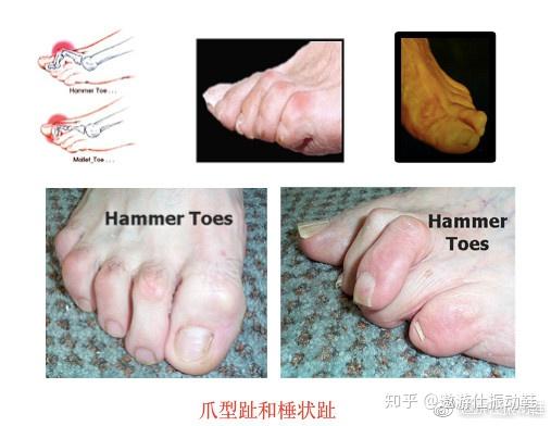 18个症状 教你不用去医院就能识别出是否是糖尿病高危足 知乎