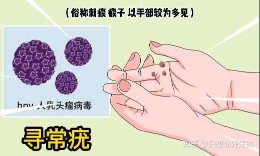 身上的小疙瘩竟是HPV感染?长在这个部位很危险,马上处理! - 知乎
