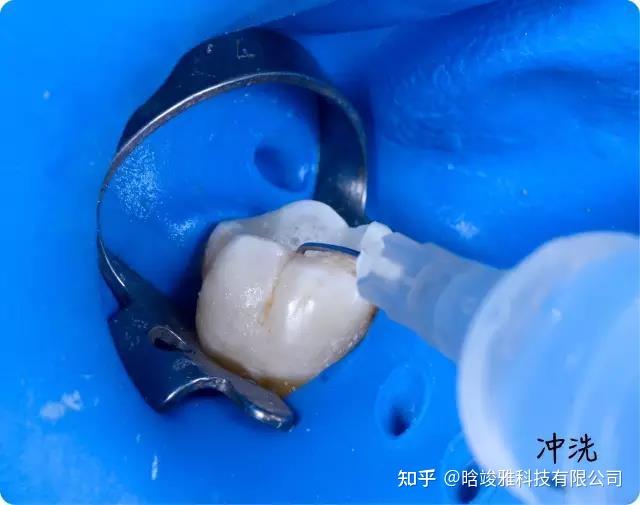 你是如何寻找根管口的？ - 知乎