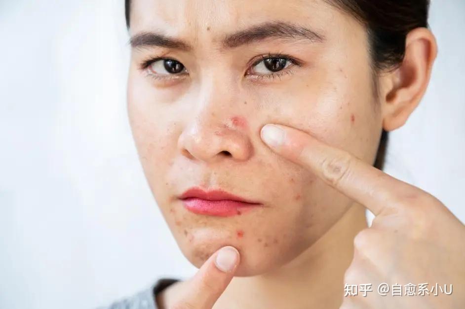U牌:皮肤上的闭口粉刺到底能不能挤 - 知乎