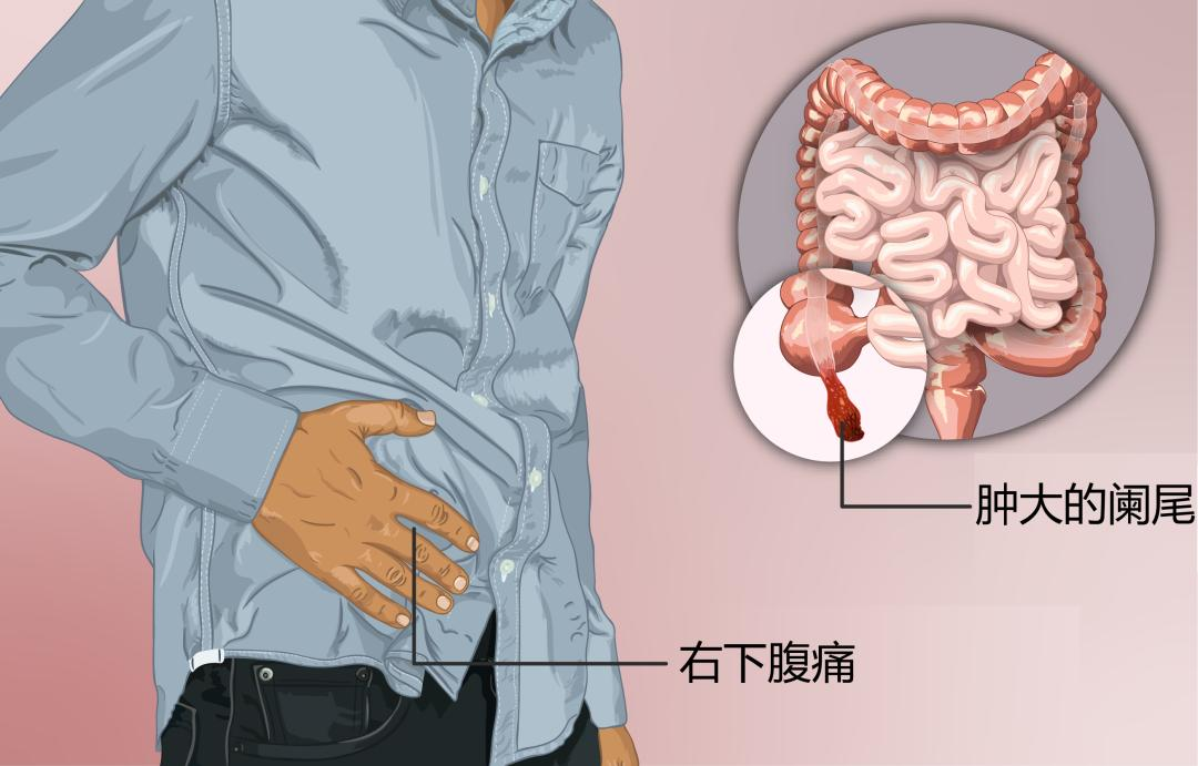慢性阑尾炎位置图片图片