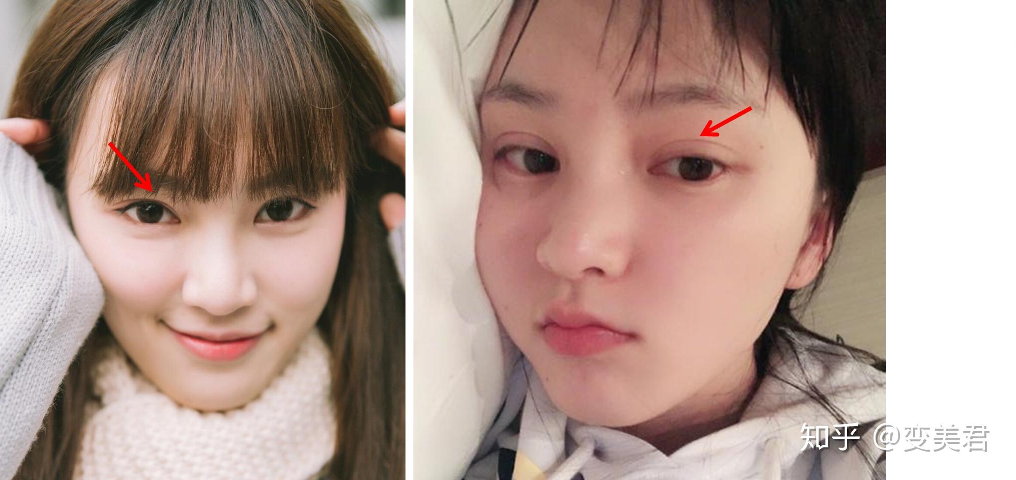 武大女神校花黄灿灿做整形如今也成馒头脸通天鼻然而骨相bug依旧存在