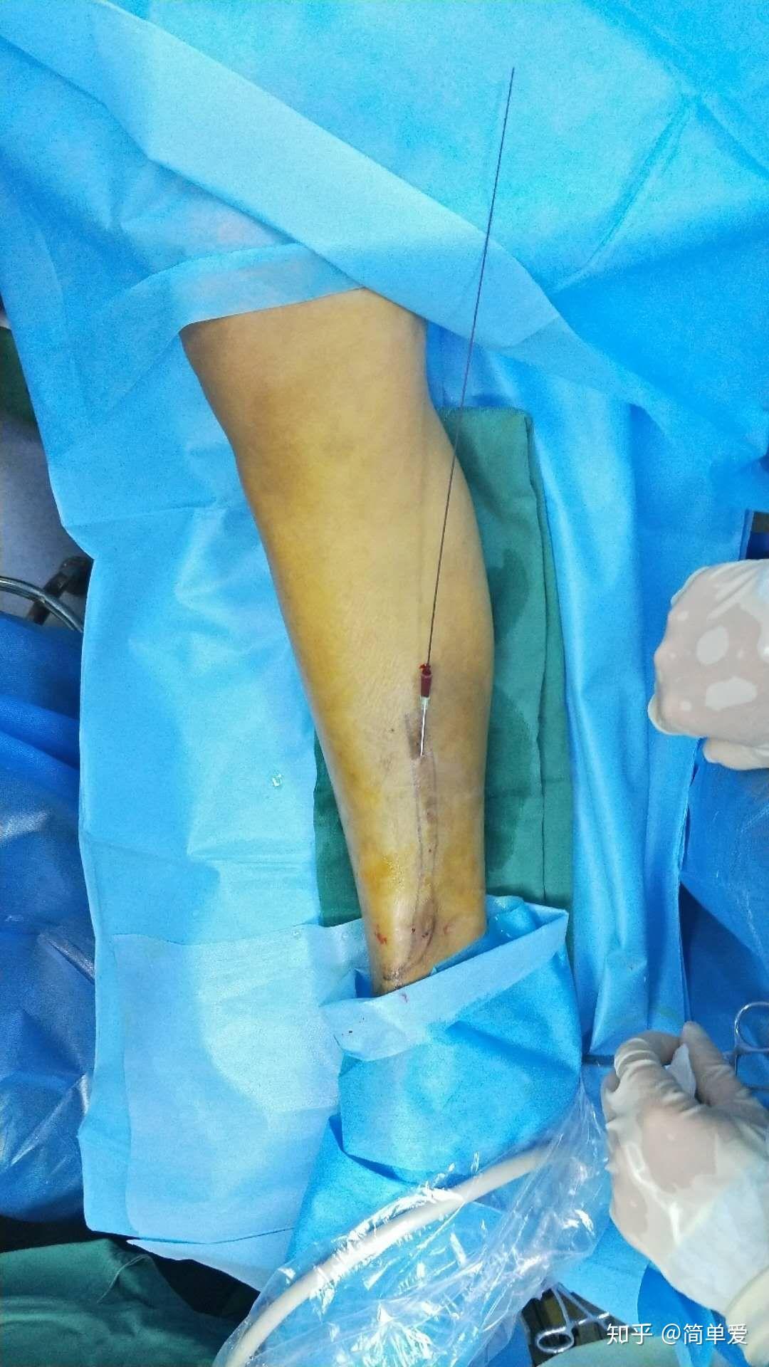 大隐静脉近心端置入5f鞘,使用50mmx40mm球囊扩张血管狭窄处.