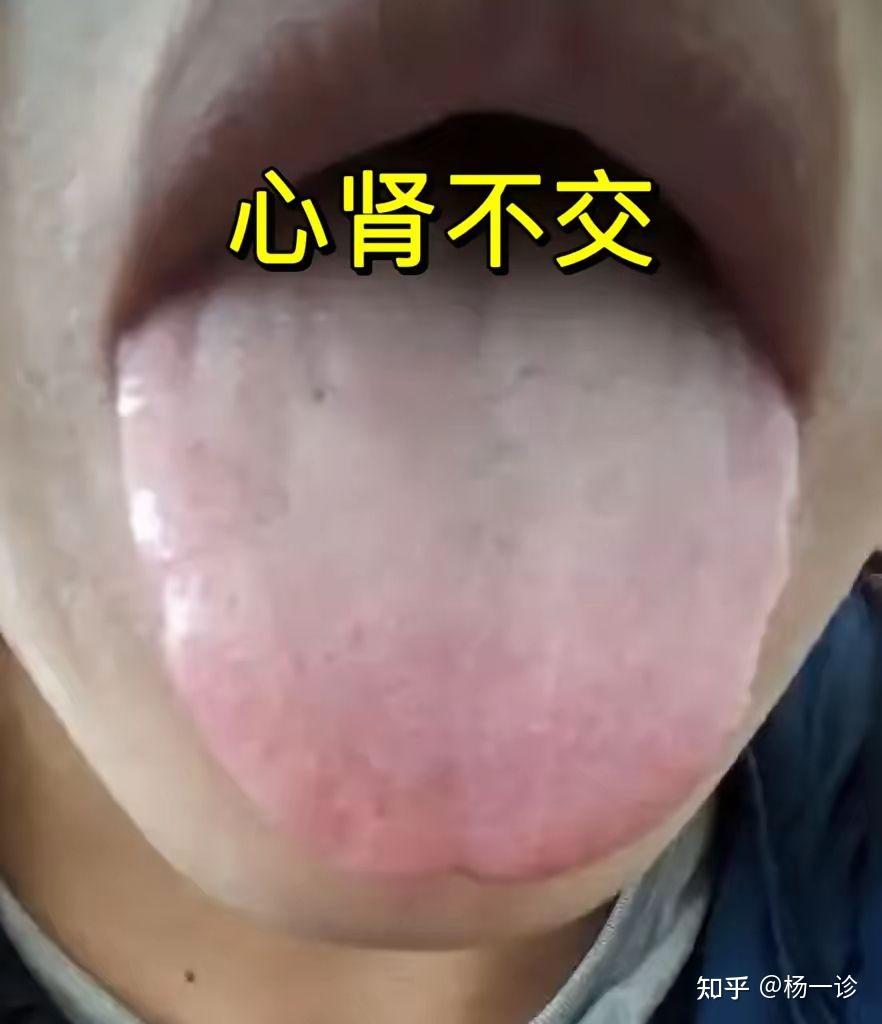 今日分享6种肾虚舌象,及典型表现,大家可以对照自身看一下自己是哪种情况 - 知乎