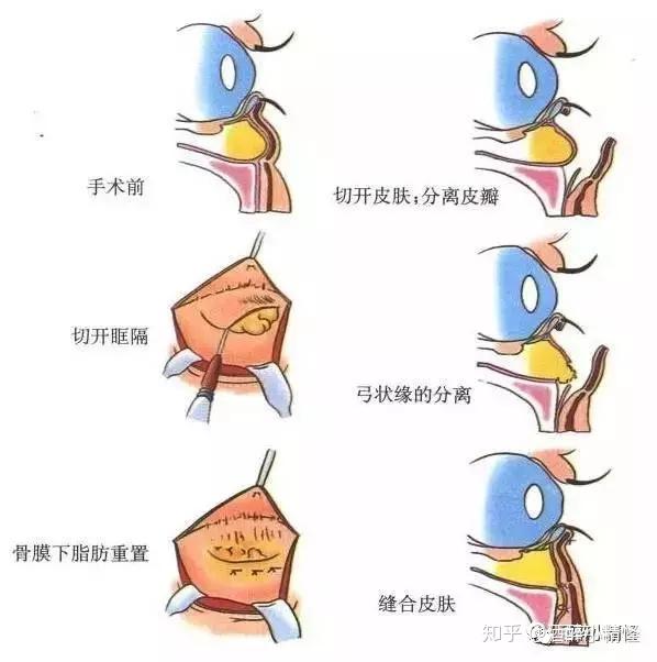 眶隔脂肪释放有泪沟又有眼袋怎么破