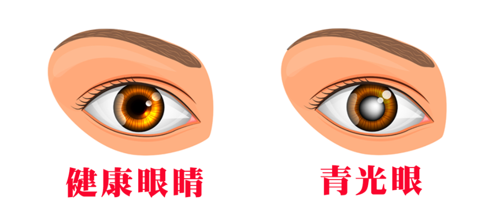 如何判断自己得了青光眼