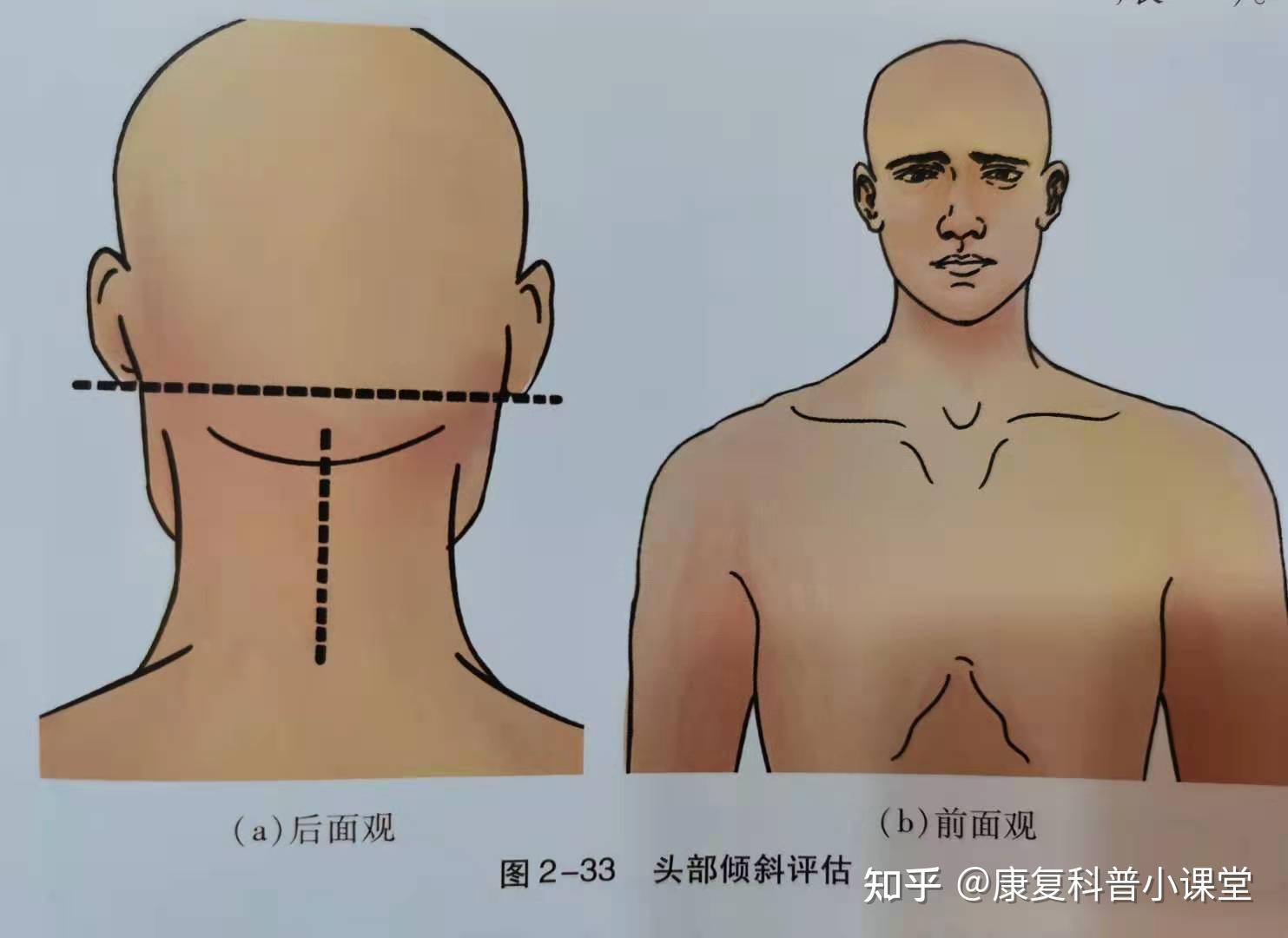 1,評估方法(1),從後部觀察耳垂是否等高(2),從前面觀察頭部的位置是否