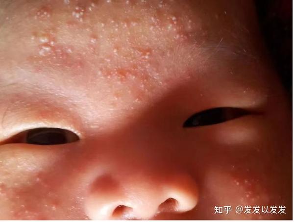 湿疹、痱子、手足口……一招教你简单辨别! - 知乎