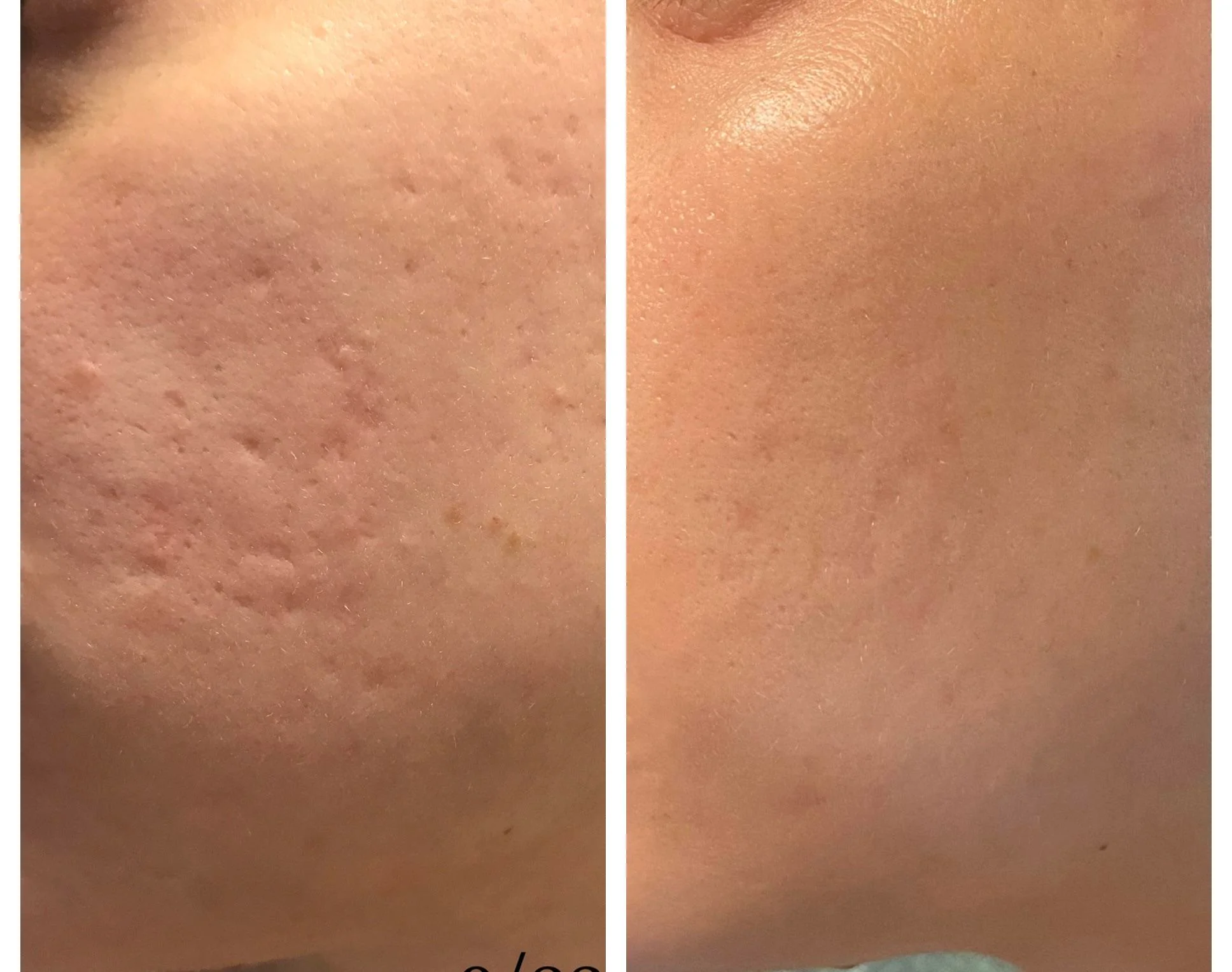 如何去除身体上的痘坑和疤痕精华总结版