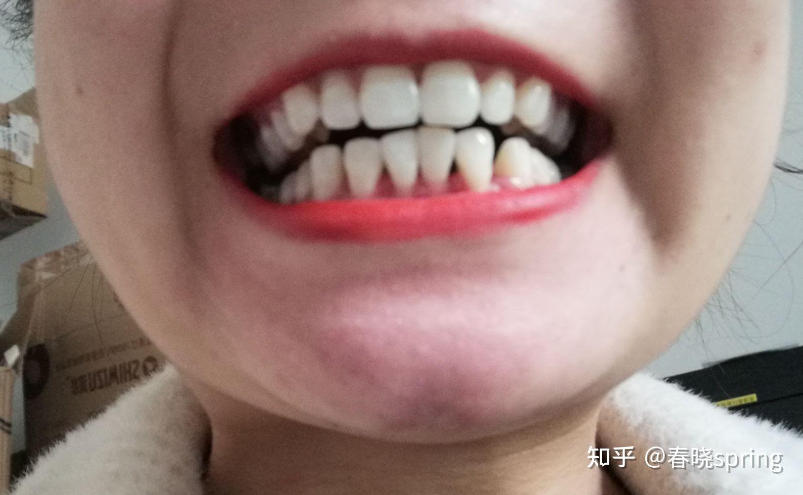 洗牙掉的牙结石图片,牙结石怎么自己去除,牙结石0度到3度的图_大山谷图库