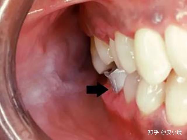 孩子嘴巴里面的白斑,哪种没啥事,哪种要严密对待呢?