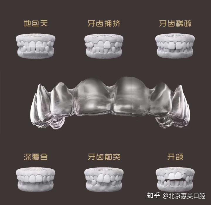 北京一个牙医的良心忠告 正畸必看 - 知乎