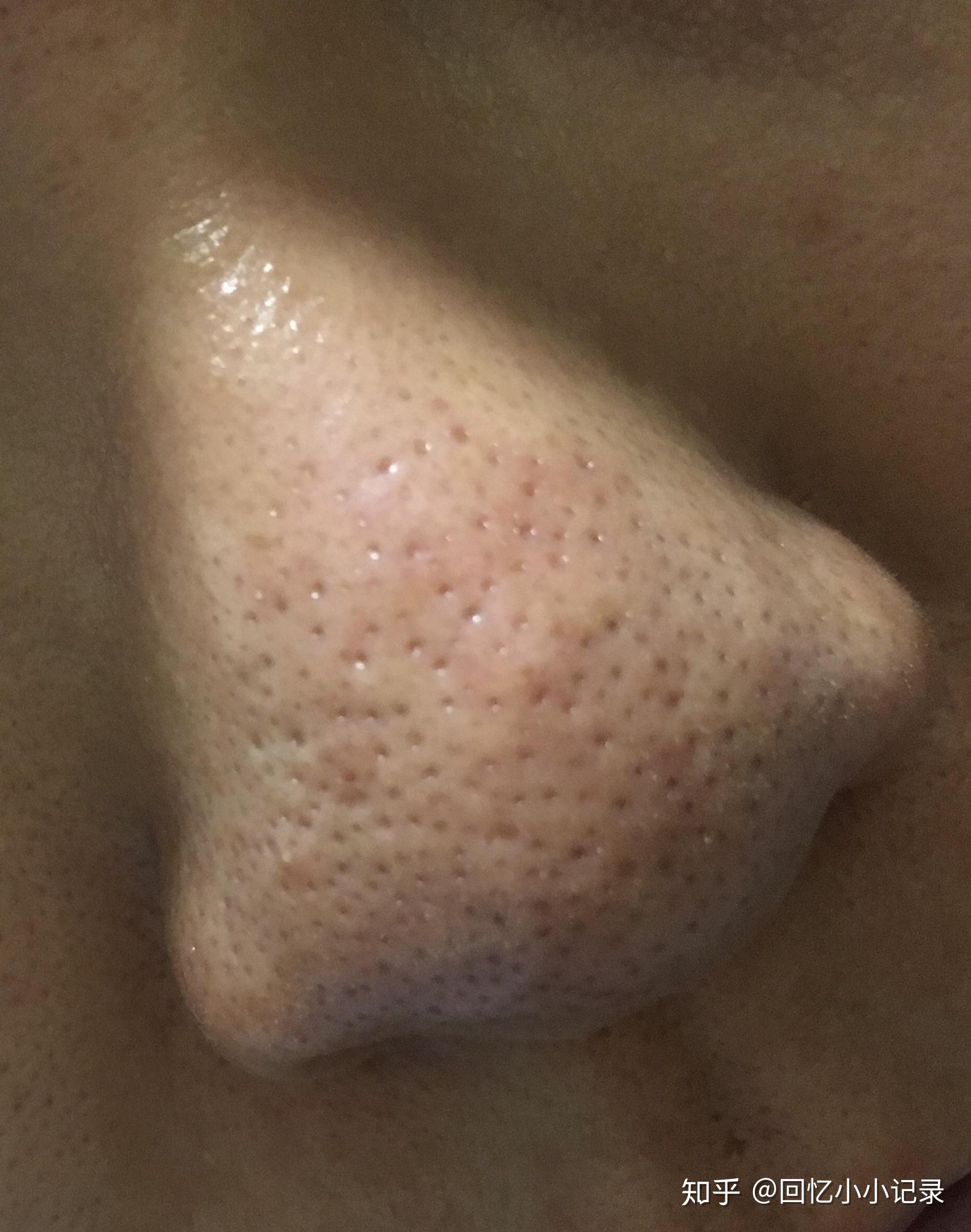 这种草莓鼻还有救吗密集恐惧症勿进