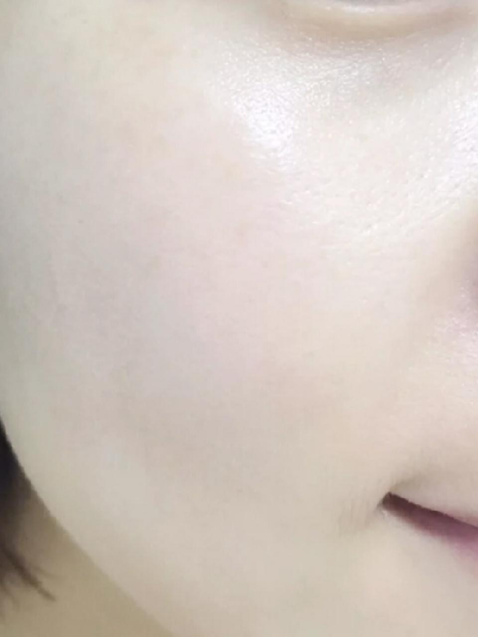 闭口怎么形成的怎么去有没有比较好的去闭口方法呀